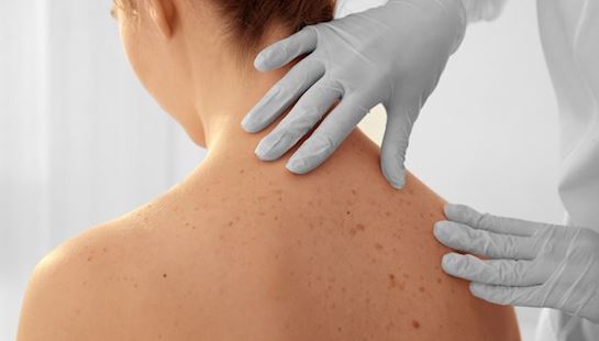 Dezembro Laranja: Prefeitura de Eusébio alerta sobre os fatores de risco do câncer de pele